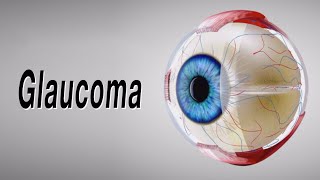 Glaucoma Animation of Why It Happens and How It Can Cause Blindness [upl. by Balbinder]