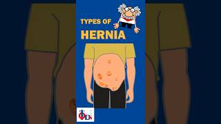 Types of hernia  DrTulip JP Nagar umbilical Inguinal Hernia [upl. by Ecydnak]