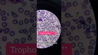 MP slide Plasmodium vivax on oil immersion 100× laboratory hematology [upl. by Llemaj]