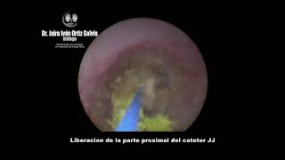 LITOTRICIA LASER EN CATETER JJ OLVIDADO Y CALCIFICADO [upl. by Ynot]