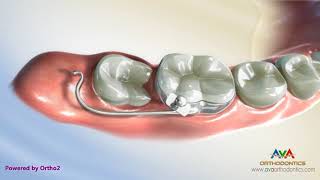 Orthodontic Treatment for Molar Uprighting  Halterman Appliance [upl. by Alyahsal]