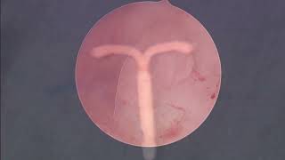 Hysteroscopic Polypectomy and Removal of Embedded Intrauterine Device IUD [upl. by Hna140]