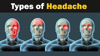 Headache  Types and causes  3d Animation [upl. by Faulkner]