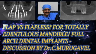 Flap vs flapless For totally edentulous mandible full arch dental implants  by DrCMurugavel [upl. by Malti791]