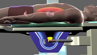 Shockwave Lithotripsy [upl. by Haveman42]