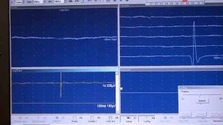 EMG JVC Fasciculaciones [upl. by Anthia]