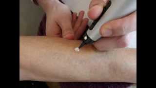 Treatment of a pigmentation spot with cryotherapy  Cryopen [upl. by Acnaib]