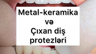 Metal keramika və çıxan diş protezləri [upl. by Sateia112]