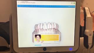 iTero Digital Scan Demo [upl. by Andre]