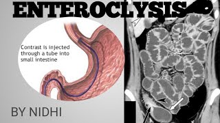 ENTEROCLYSIS PROCEDURE IN HINDI  ENTEROCLYSIS [upl. by Aztinaj]