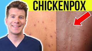 Doctor explains CHICKENPOX  Causes Stages Symptoms Treatment PLUS PHOTOS [upl. by Deerc]