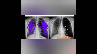 Internal Medicine  Pulmonology Pneumothorax [upl. by Bloch72]