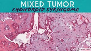 Chondroid Syringoma Mixed Tumor 5Minute Pathology Pearls [upl. by Hubie966]