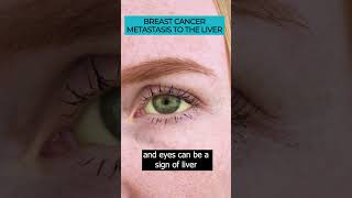 Identifying Symptoms of Breast Cancer Metastasis to the Liver 🎗️Cancer Metastasis LiverMetastasis [upl. by Mikah]