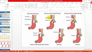 Tracheoesophageal Fistula TEF 2020 04 06 071811 [upl. by Frum]