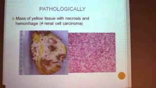 XanthoGranulomatis Pyelonephritis  Alexandra BENARROUS [upl. by Christmas]