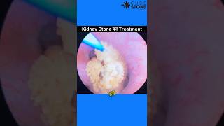 Kidney stone treatment  RIRS  Retrograde Intrarenal Surgery  URSL shortsviral [upl. by Sidhu]