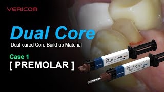 Dual Cured Core Build up Material Prmolar 1 [upl. by Ramo]