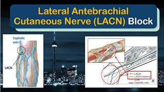 LATERAL ANTEBRACHIAL CUTANEOUS NERVE Block  A quotHowToquot Guide [upl. by Hussey]