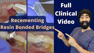 RBB Recementation Protocol  Adjusting Pontic Occlusion [upl. by Carboni]