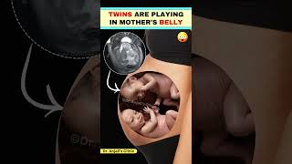 Twins movement in the womb  Fetal movement  Baby Kicks shortsvideo pregnancy love [upl. by Ibrad525]