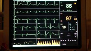 ECG  Extrasystole [upl. by Yawnoc]