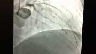 OutPatient LAD Angioplasty via Radial Artery Wrist by Dr Sanjay Patel [upl. by Atneciv587]