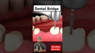 Amalgam removal and Dental Bridge Process 3D animationyt shorts 3d animation ytvideo asmr [upl. by Maddi368]