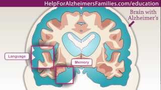 Alzheimer’s Society – Bookcase Analogy [upl. by Fitzgerald]