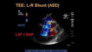 Transesophageal Echocardiography Shunts and Bubble Study [upl. by Karoline]