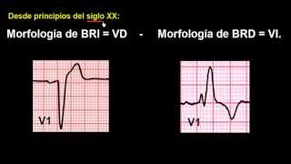 CURSO DE ELECTROCARDIOGRAFIA 48  EXTRASÍSTOLES VENTRICULARES [upl. by Enelyahs]