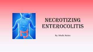 Necrotizing enterocolitis  definition clinical features investigations management [upl. by Egiaf]