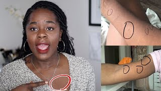 My Skin Story  How I got rid of Pityriasis Rosea  TheAdeTomi [upl. by Cacilia]