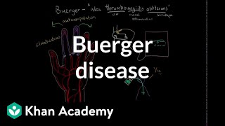 Buerger disease  Circulatory System and Disease  NCLEXRN  Khan Academy [upl. by Kape]