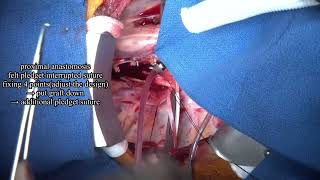 kommerells diverticulum 5 subtitled edition [upl. by Genny580]