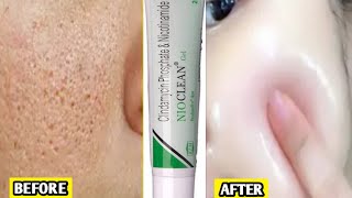 Nioclean Gel for Acne  Clindamycin and Nicotinamide Gel for acnenioclean gel how to use [upl. by Marcin]