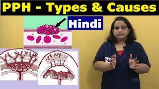 Postpartum hemorrhage in Hindi  Causes and Types of PPH  Nursing Lecture [upl. by Chrystel]