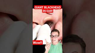 Giant BLACKHEAD REMOVAL FROM EAR  The Biggest I Have Seen shorts [upl. by Anivahs781]