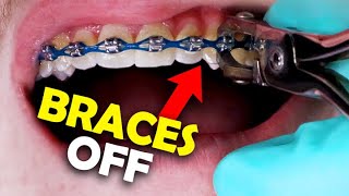 Braces Removal A StepbyStep Guide by an Orthodontist [upl. by Amero609]