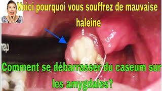 Voici pourquoi vous souffrez de mauvaise haleine Comment se débarrasser du caseum sur les amygdales [upl. by Brannon]