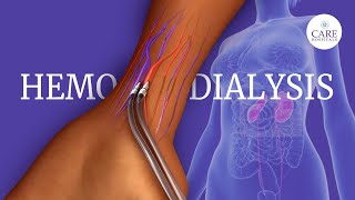 What is Hemodialysis  How is Hemodialysis Done [upl. by Hollis208]