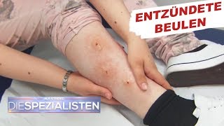 Beulen an den Beinen Parasitenbefall  Auf Streife  Die Spezialisten  SAT1 TV [upl. by Aryamo]