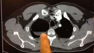 Clinical Case Pulmonary Abscess [upl. by Koerlin]