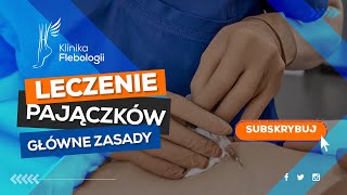 Leczenie pajączków  główne zasady [upl. by Lrac]