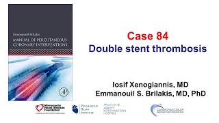 Case 84 PCI Manual  Double stent thrombosis [upl. by Anillek]