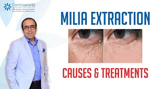 Milia Extraction Causes and Treatment  Milia under the eyes  Dr Rohit Batra [upl. by Annaerdna]