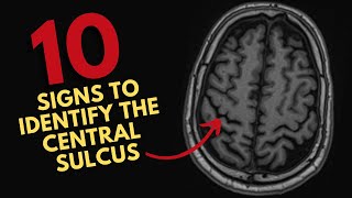 How to find the central sulcus on MRI [upl. by Thevenot]