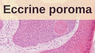 Eccrine Poroma  Pathology mini tutorial [upl. by Amat]