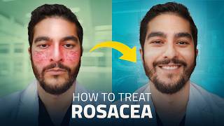 Struggling with Rosacea Here Are the Best Treatments for 2024 [upl. by Aiyotal]