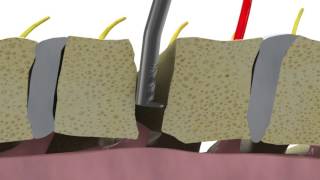 Removing osteophytes during ACDF using Dreal® technology [upl. by Mitchel]